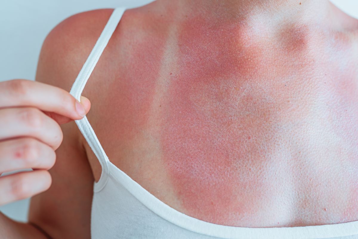 Sonnenbrand im Main-Tauber-Kreis: Richtig vorbeugen, schnell